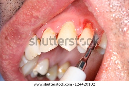 The doctor cleaning the teeth with ultrasonic tool, bleeding mucous