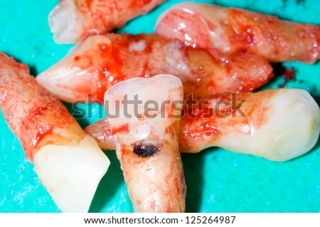 Extracted teeth, part of prosthetic treatment