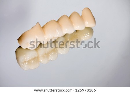 Dental porcelain bridge  using the indirect method of restoration
