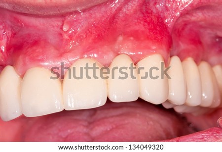 Ceramic dental bridge in patients mouth after treatment