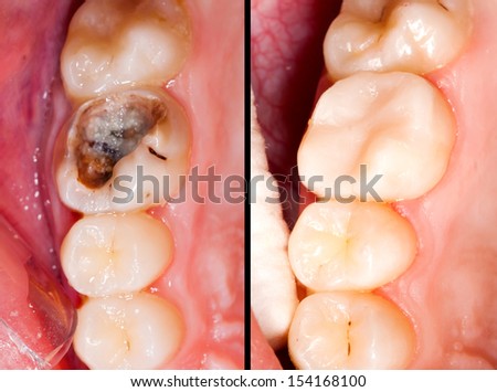 Decayed tooth before and after restorative treatment