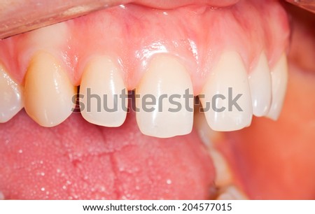 Spaces between upper frontal tooth