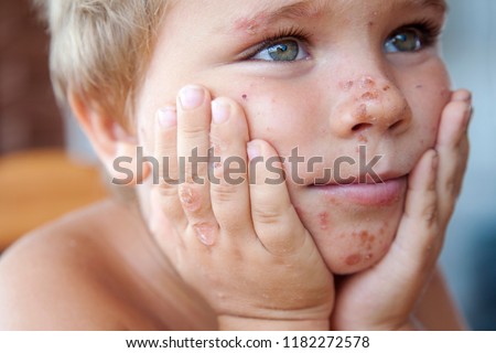 A little boy with a skin disease. Skin diseases. Burns and blisters. Childhood diseases. Psoriasis.