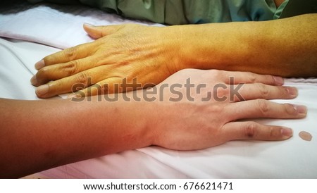 Jaundice patient with yellowish discoloration of skin in comparison with Normal Skin color.
