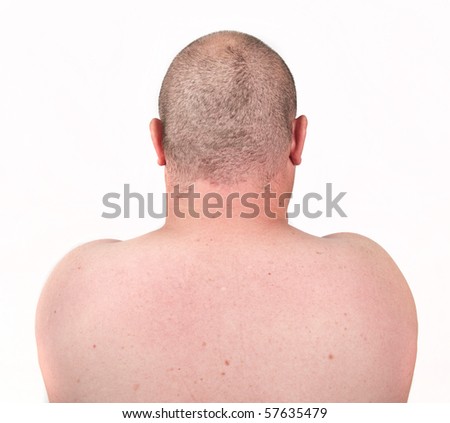 male close up picture of back and shaved thinning hair