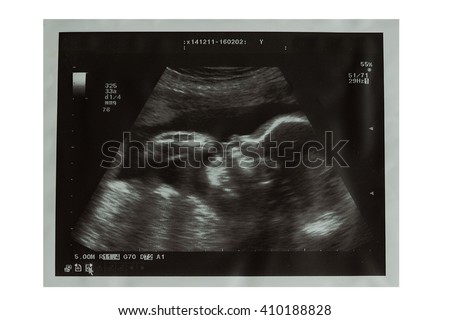 Ultrasound picture of baby isolated. Ultrasound scan of a twenty four week old fetus in a profile view lying on its back and sucking finger. Ultrasound of baby in pregnant woman.