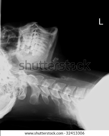 Neck x-ray