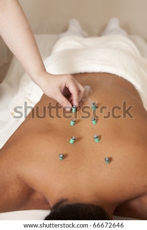 alternative health care,burning moxa on a patients back in an alternative medicine clinic
