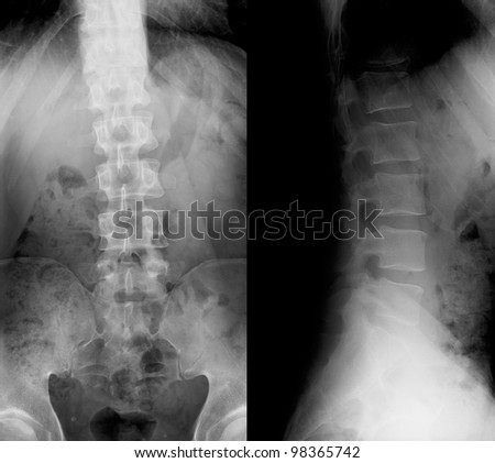 X-ray of the lumbar spine that curves
