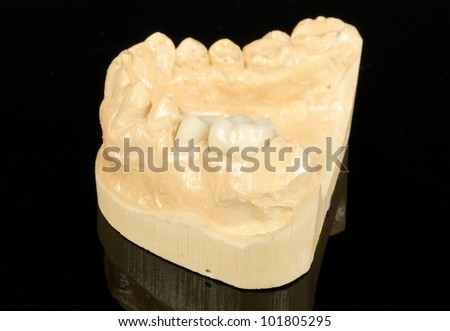 metal free dental crowns, partly finished with model