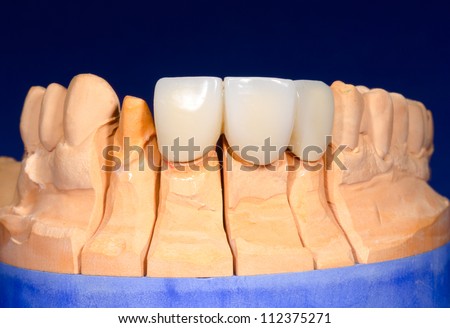detail plaster model with dental bridge