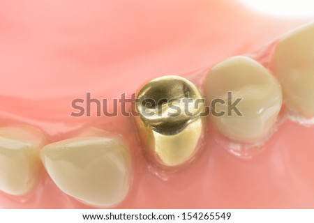 gold tooth in old fashioned denture