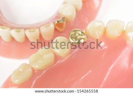 dental gold, worn dentures