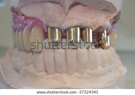 construction of denture with inner gold crowns