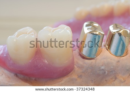 dental technology, artificial teeth plus inner gold crowns