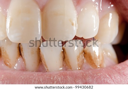 macro, dirty aged front teeth (lower front sharp)
