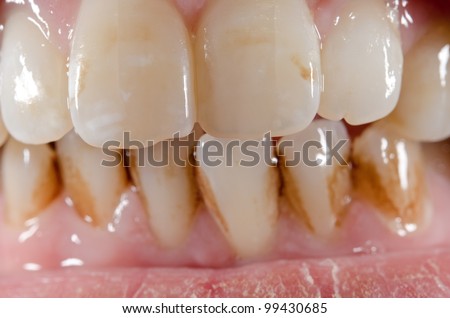 dirty aged front teeth macro (upper row sharp)
