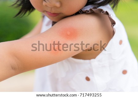 Little Asian girl has allergies with mosquitoes bite.Mosquito sucking blood on child skin