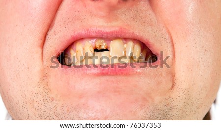 Young man mouth with broken tooth, closeup view isolated on white