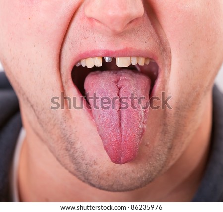 Broken Tongue
