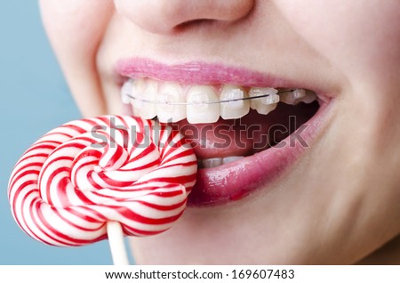 Beautiful Smile With Aesthetic Braces Eating Candy