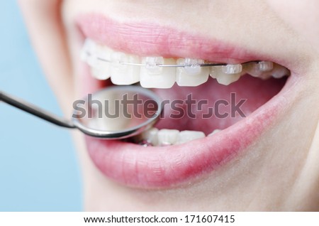 Beautiful Smile With Aesthetic Braces