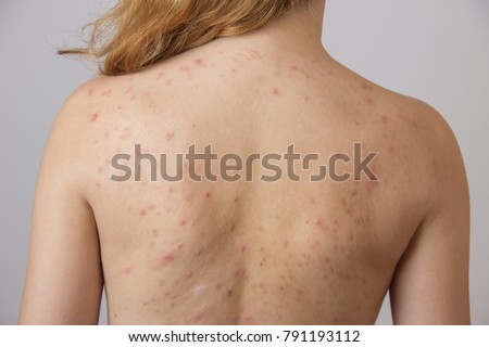 Young girl with acne, with red and white spots on the back