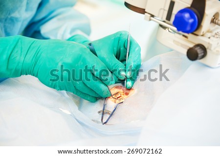 ophthalmology surgery. Surgeon\'s hands in gloves performing laser eye vision correction correction