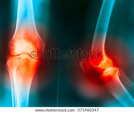 X-ray of knee joint pain cause by knee trauma, gout, rheumatoid, osteoarthritis of knee