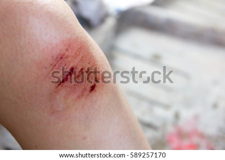 Bruised wound injury on woman knee background