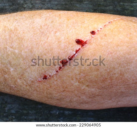A mans arm placed on a board with a long slice/cut/wound going across it with blood on it drying up