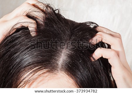 Dander that causes itching scalp
