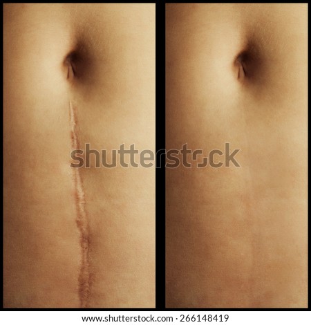 scar on the abdomen after surgery. Before and after removal