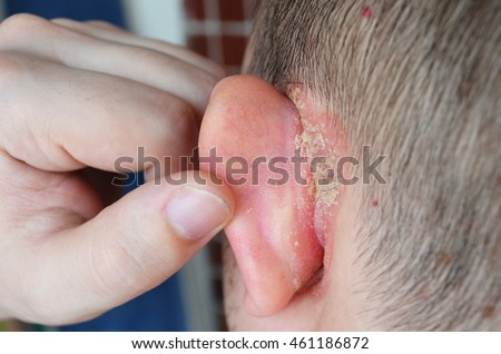 Psoriasis behind the ear,  pushes the ear, dermatological problems, skin diseases