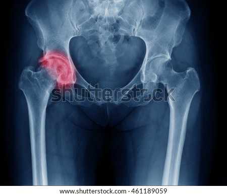 X-ray image of painful hip in woman present Osteoarthritis right hip joint at red area mark