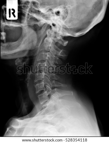 X-ray of neck and cervical spine, side view.