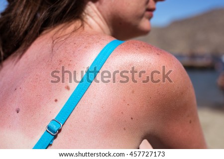 Sunburn from beach sun light on the shoulder and back of caucasian girl,woman at the vacation beach on holiday in summer.Awareness of skin cancer.