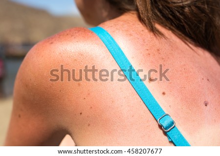 Sunburn from beach sun light on the shoulder and back of caucacian girl,woman at the vacation beach on holiday in summer.Awareness of skin cancer.