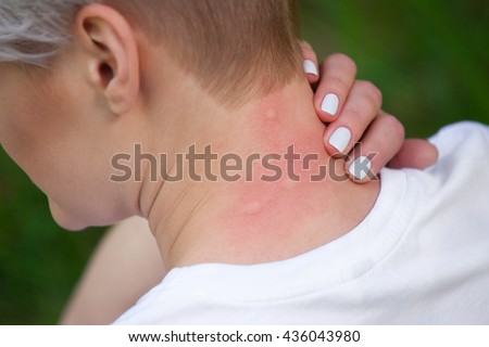 Girl with blond hair, sitting with his back turned and scratching bitten, red, swollen neck skin from mosquito bites in the summer in the forest.  Close-up up of visible insect bites. Irritated skin.