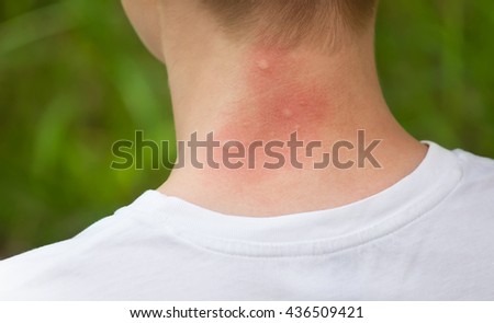 mosquito bites. Girl with blond hair, sitting with his back to turn. Close-up of visible red, swollen neck skin from mosquito bites in the summer in the woods. Insect bites. Irritated skin.