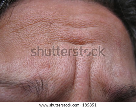 Wrinkles - forehead showing tension and fear