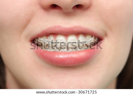 The girl smiles with braces system.