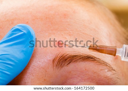 Acne treatment with injection on the sebaceous glands