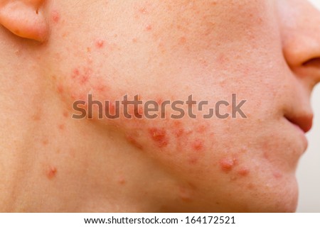 Acne Skin Because The Disorders Of Sebaceous Glands Productions