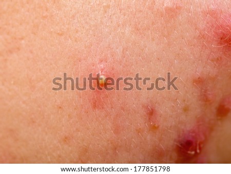 Acne skin because the disorders of sebaceous glands productions
