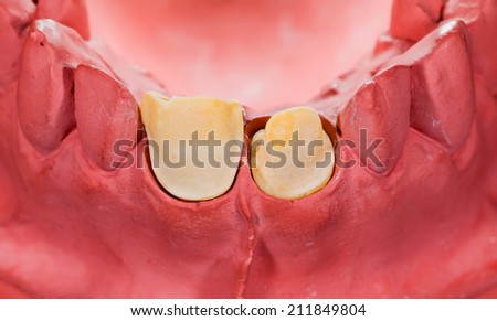 Closeup photo of polished incisor tooth on red gypsum model