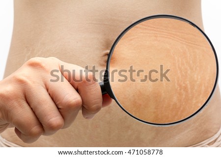 Stretch marks ,belly,Magnifier