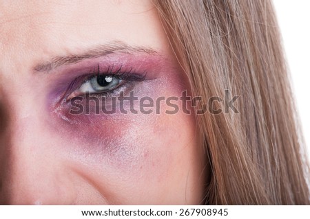 Closeup of a black eye of a beaten woman as a domestic violence victim