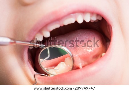 Closeup of kid or child mouth at dentist. Dental mirror and teeth reflection