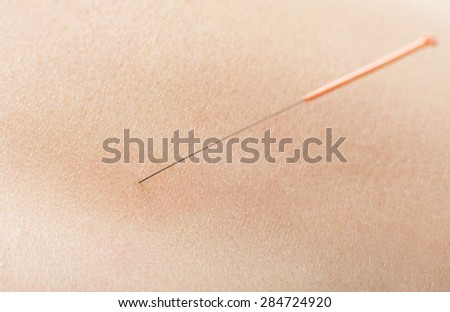 acupuncture, needle in skin , very close up